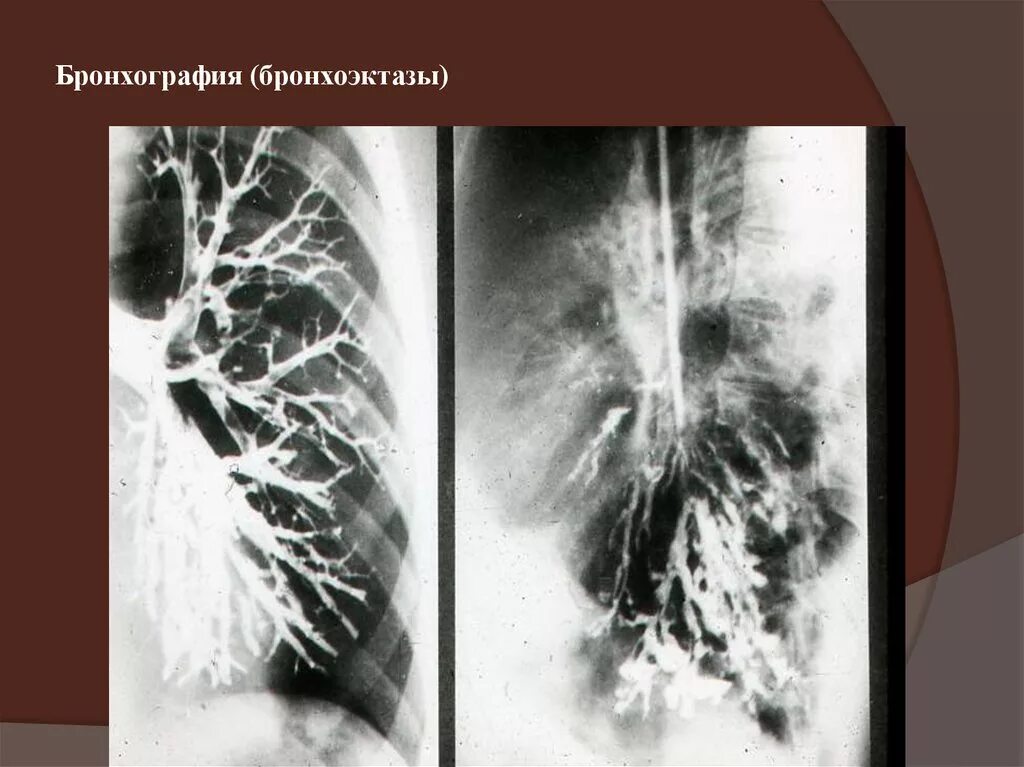 Бронхография бронхоэктазы. Бронхоэктатическая эмфизема. Бронхоэктаза правого легкого. Мешотчатые бронхоэктазы рентген. Бронхоэктатическая болезнь легких.
