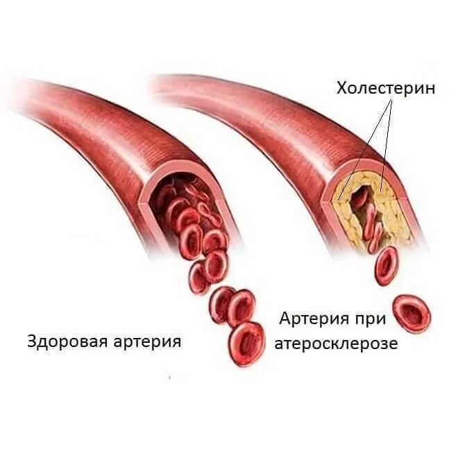 Закупорка кровеносных сосудов. Закупорка головных сосудов