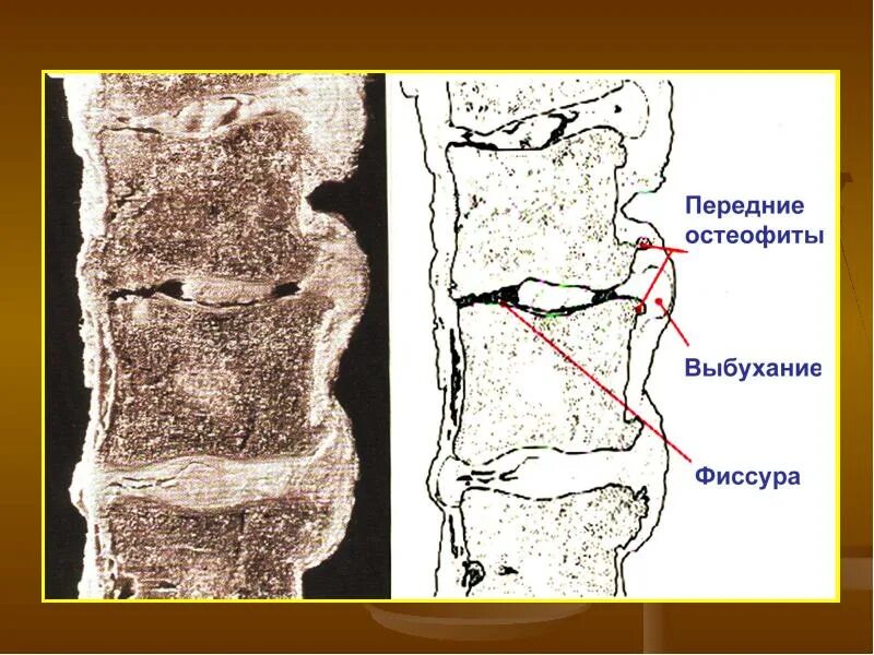 Остеофиты что это такое и как лечить. Передние остеофиты. Остеофиты краевых замыкательных пластин. Передне боковые остеофиты.