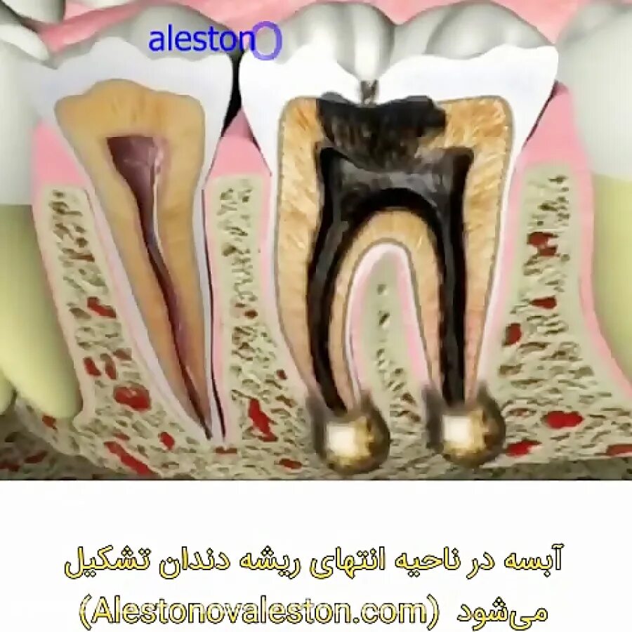 Временное лечение каналов зуба