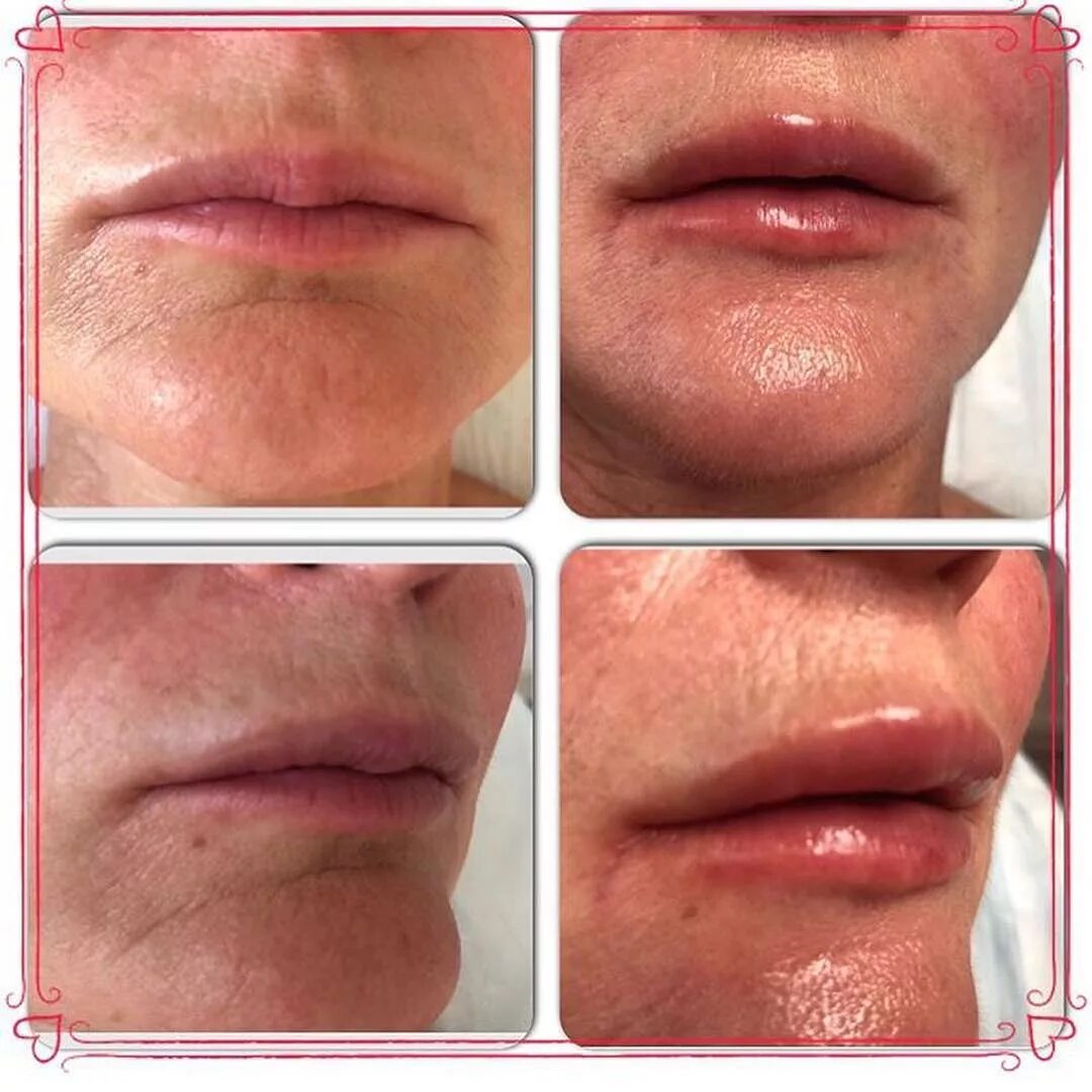 поднять уголки губ до после. корнер-лифт (подтяжка углов рта). поднятие уголков губ пластика. контурная пластика поднять уголки губ. поднятие уголков губ филлерами.