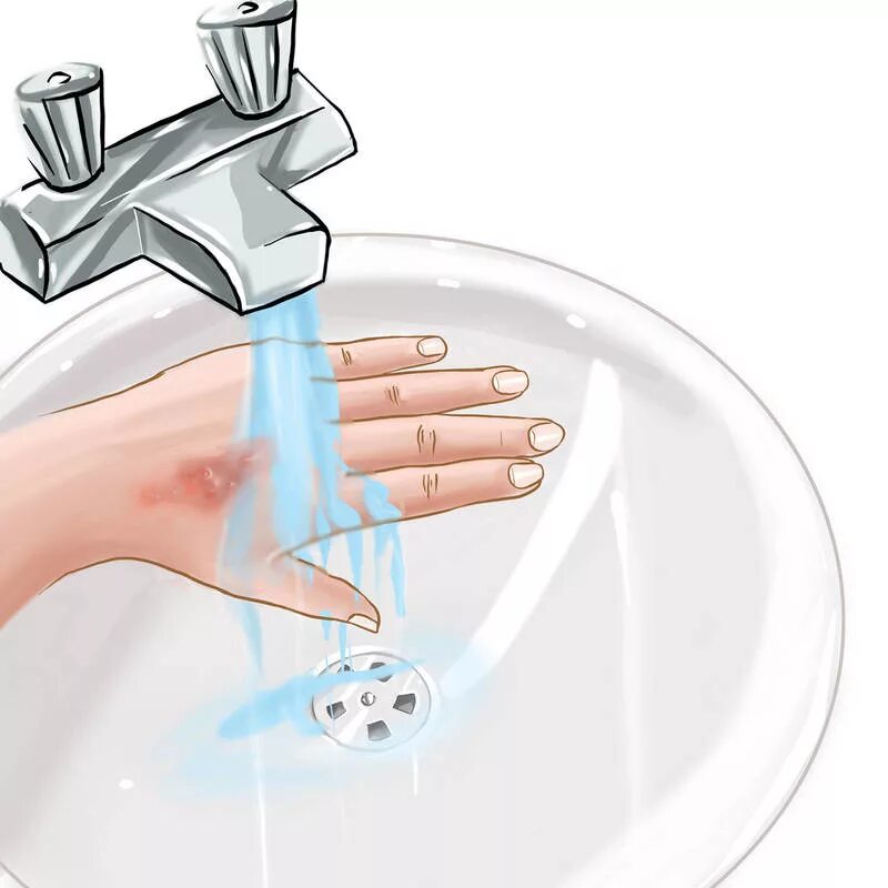 промывание химических ожогов. ожоги под проточной водой. место промытое водой. место промытое водой. попадание дез средства в глаза.