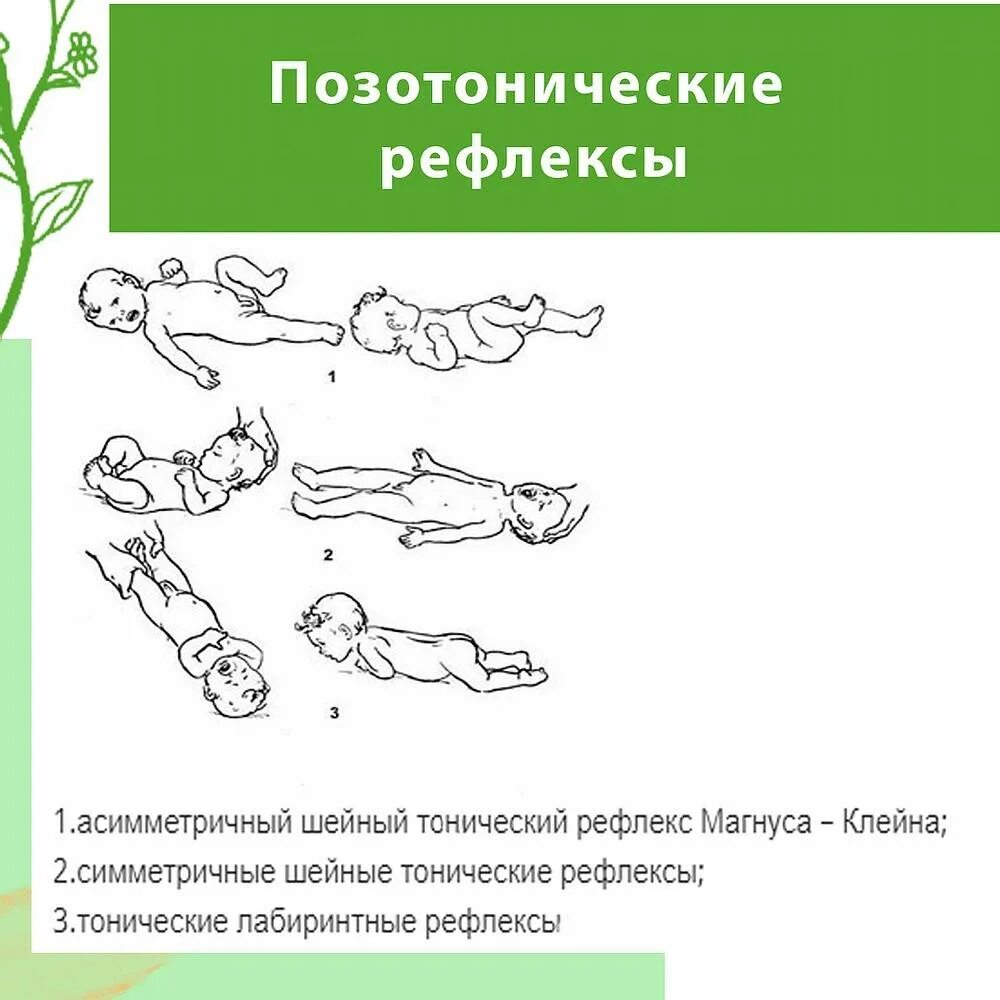 Р рефлекс. Лабиринтный тонический рефлекс у новорожденных. Шейные рефлексы Магнуса. Симметричный шейный тонический рефлекс при ДЦП. Позотонические рефлексы у детей с ДЦП.