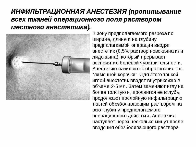 Инфильтрационная анестезия в стоматологии методика проведения. Инфильтрационная анестезия поверхностных мягких тканей. Инфильтрационная анестезия верхних боковых резцов.. Местная инфильтрационная анестезия по Вишневскому.