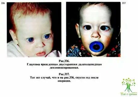 Сходящееся косоглазие код по мкб у детей