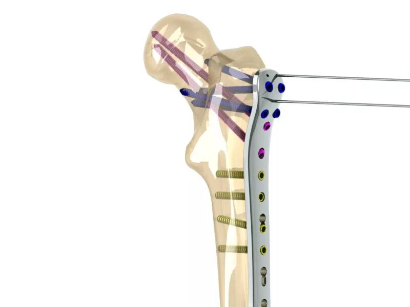LCP пластины для остеосинтеза. Остеосинтез бедренной кости. Наружный остеосинтез бедренной кости.