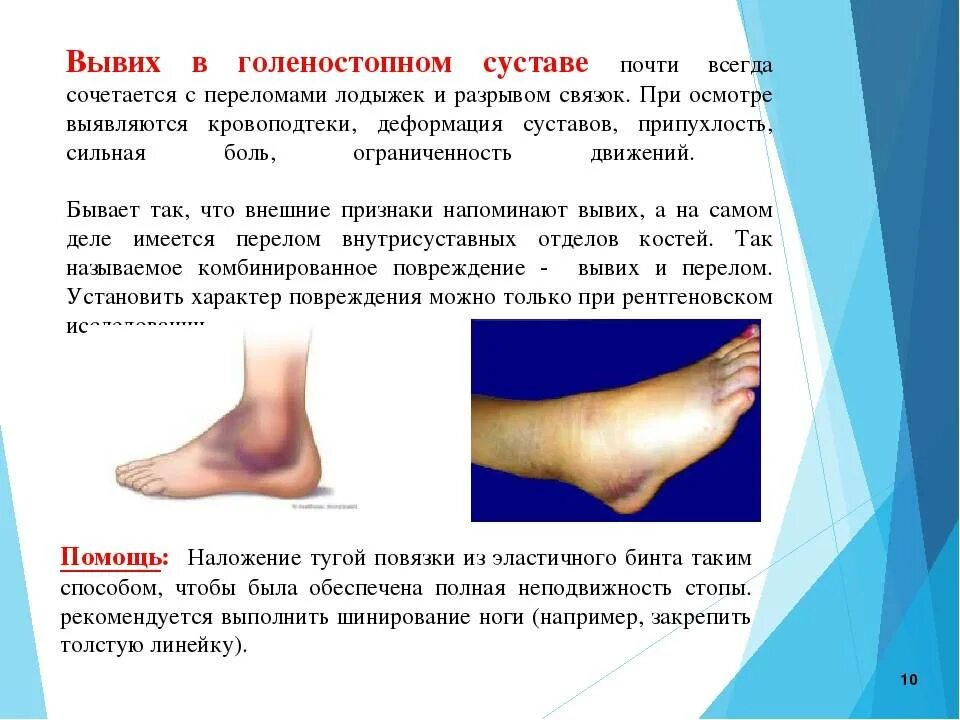 Вывих голеностопного сустава. Выверхголеностопного сустава. Растяжение голеностопного сустава. Разрыв связок голеностопного сустава.