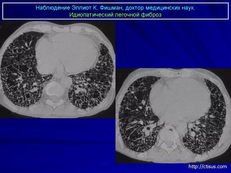 Фиброз легких врач. Легочный фиброз кт. Идиопатический легочный фиброз кт. Идиопатический фиброзирующий альвеолит кт. Интерстициальный фиброзирующий альвеолит кт.