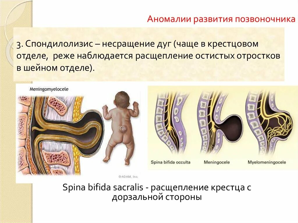 Аномалии развития позвоночника. Дефекты позвонков врожденные. Спинномозговая грыжа spina Bifida. Врождённая аномалия позвонка расщепление. Аномалии развития позв.