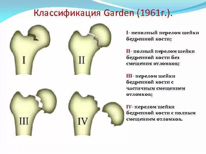 Шейка бедра операция отзывы. Классификация Гардена перелом шейки бедра. Классификация Garden переломы шейки бедра. Переломы шейки бедра классификация рентген. Шейка бедра перелом классификация.