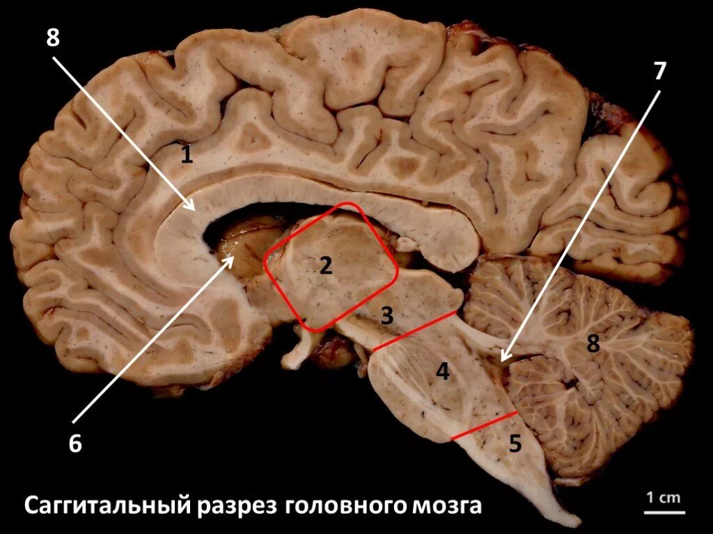 Головной мозг 4 класс. Сагиттальный срез головного мозга анатомия. Сагиттальный разрез мозга анатомия. Сагиттальный разрез головного мозга препарат. Медиальный разрез головного мозга.