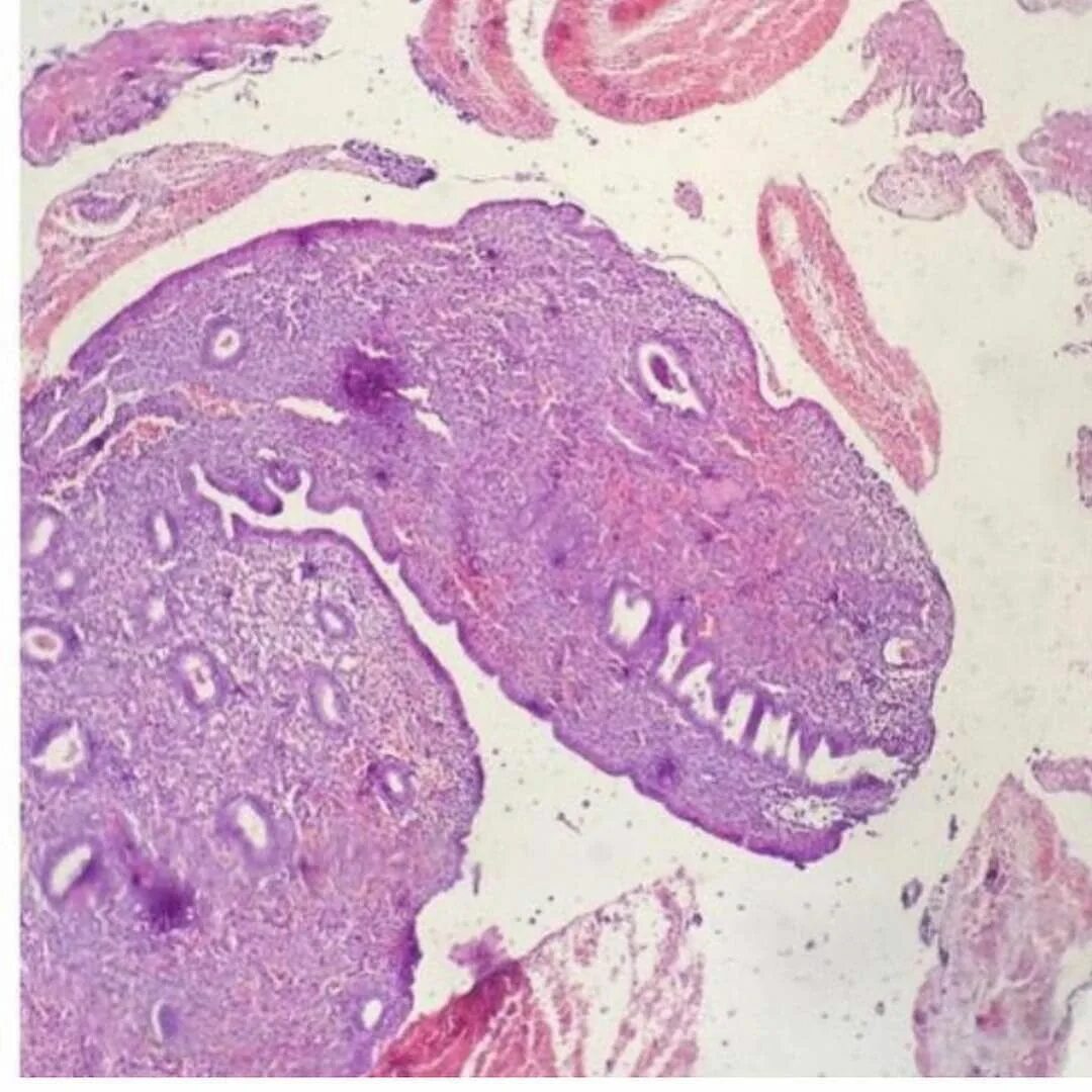Гестион гистология. Трубная беременность патологическая анатомия микропрепараты. Гистологические препараты. Хорионэпителиома микропрепарат.