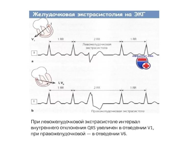 Qrs на экг что это. Левожелудочковая экстрасистола на ЭКГ. Правожелудочковая экстрасистолия на ЭКГ. Желудочковые экстрасистолы грудные отведения ЭКГ. Левожелудочковая и правожелудочковая экстрасистола.