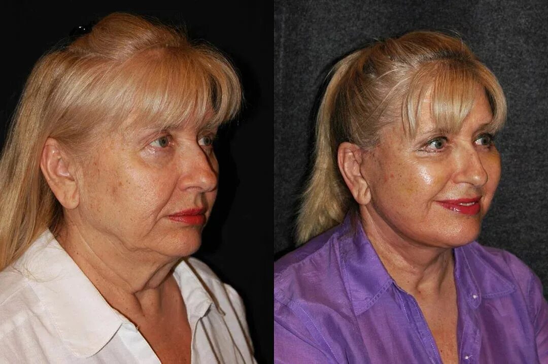 Подтяжка после 60. Красивые женщины в 50 лет без пластики. Лицо в 50 лет без пластики. Обычная женщина 60 лет.