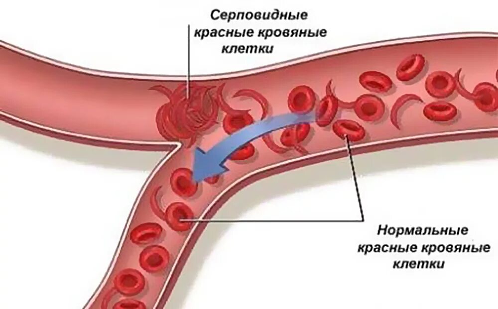 Ген серповидноклеточной анемии. Клеточная анемия серповидноклеточная. Серповидноклеточная анемия эритроциты. Серповидноклеточная анемия мазок. Серповидноклеточная анемия симптомы.