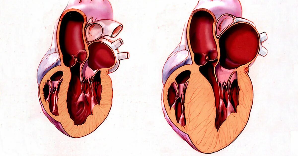 Необструктивная гипертрофическая кардиомиопатия. Обструктивная гипертрофическая кардиомиопатия. Гипертрофическая кардиомиопатия необструктивная форма. Гипертрофия и дилатация миокарда. Миокард правого желудочка сердца