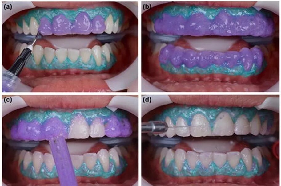 Зуб отбеливание пить. Опалесценс химическое отбеливание. Химическое отбеливание Opalescence. Лазерное отбеливание Opalescence Boost. Химическое отбеливание Opalescence этапы.