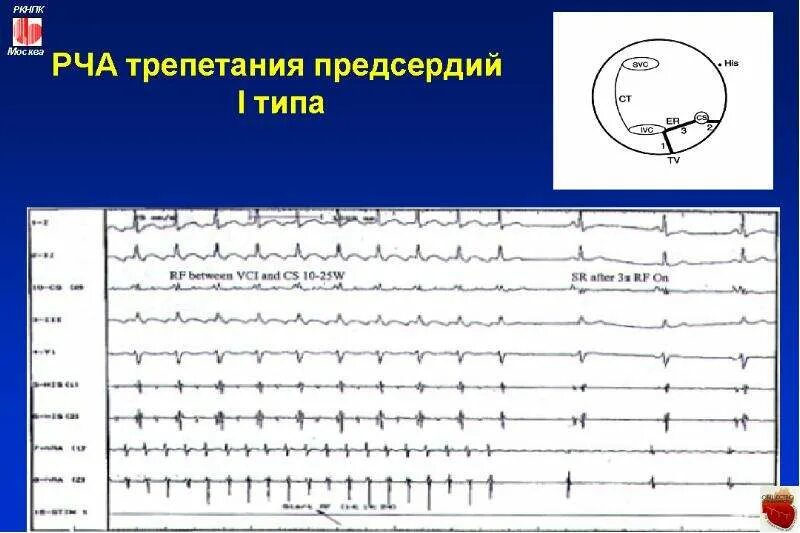 Рча предсердий. Радиочастотная катетерная абляция фибрилляции предсердий. РЧА трепетания предсердий. Радиочастотная абляция при wpw. РЧА при трепетании.