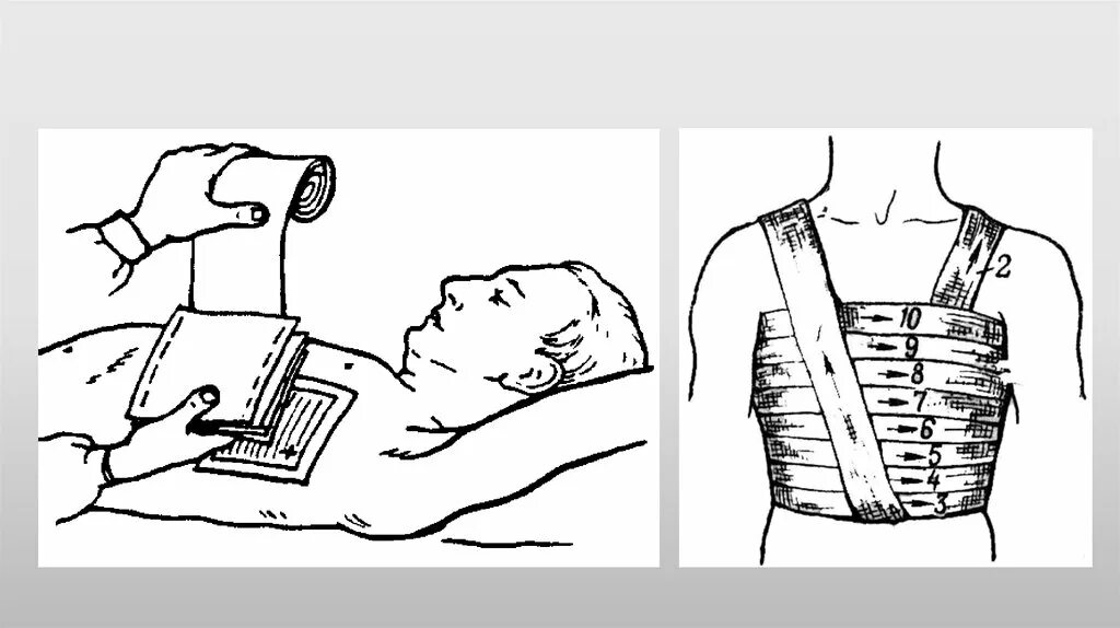 Повязка на грудную клетку алгоритм. Окклюзионная повязка при пневмотораксе алгоритм. Техника наложения окклюзионной повязки при пневмотораксе. Окклюзионная повязка при открытом пневмотораксе. Окклюзионная повязка алгоритм наложения.
