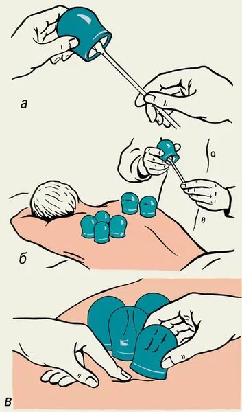 Сколько можно ставить банке. Как ставить банки алгоритм. Постановка банок на спину алгоритм. Постановка вакуумных банок алгоритм. Схема постановки медицинских банок.