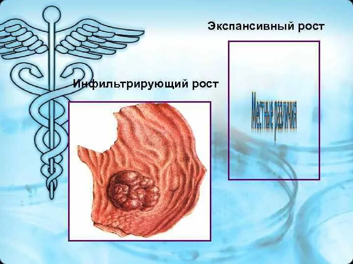 Экспансивный рост это. Эндофитный рост опухоли рисунок. Экспансивный рост опухоли. Экспансивный и инфильтративный рост опухоли. - Экспансивный рост - инфильтрирующий рост.