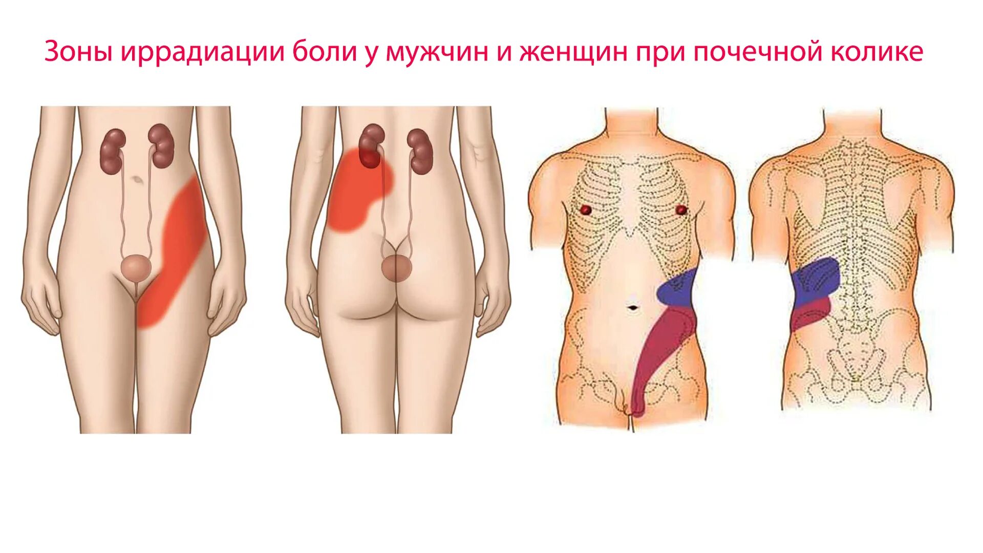 Локализация боли в почках. Иррадиация боли при почечной колике.