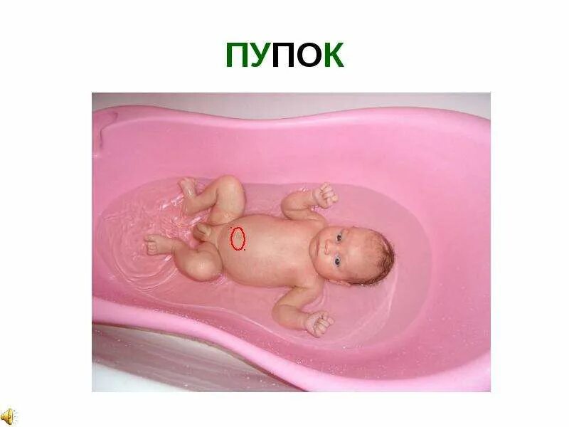 Solution or Remedy for Umbilical Hernia in infants or New borns /Air filled baby