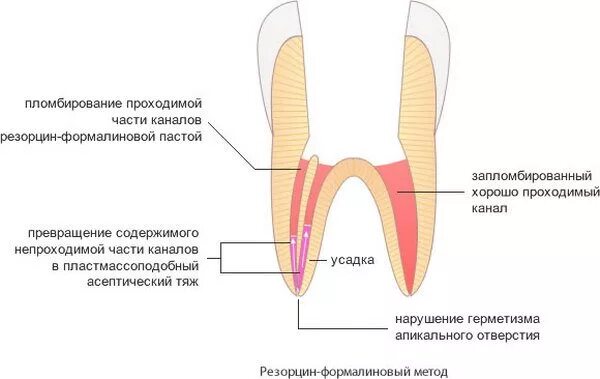 Методы пломбирования корневых. Резорцин формалиновый метод зуб. Схема резорцин формалинового метода. Зубы леченные резорцин формалиновым методом. Сочетание метода серебрения и резорцин – формалинового метода.