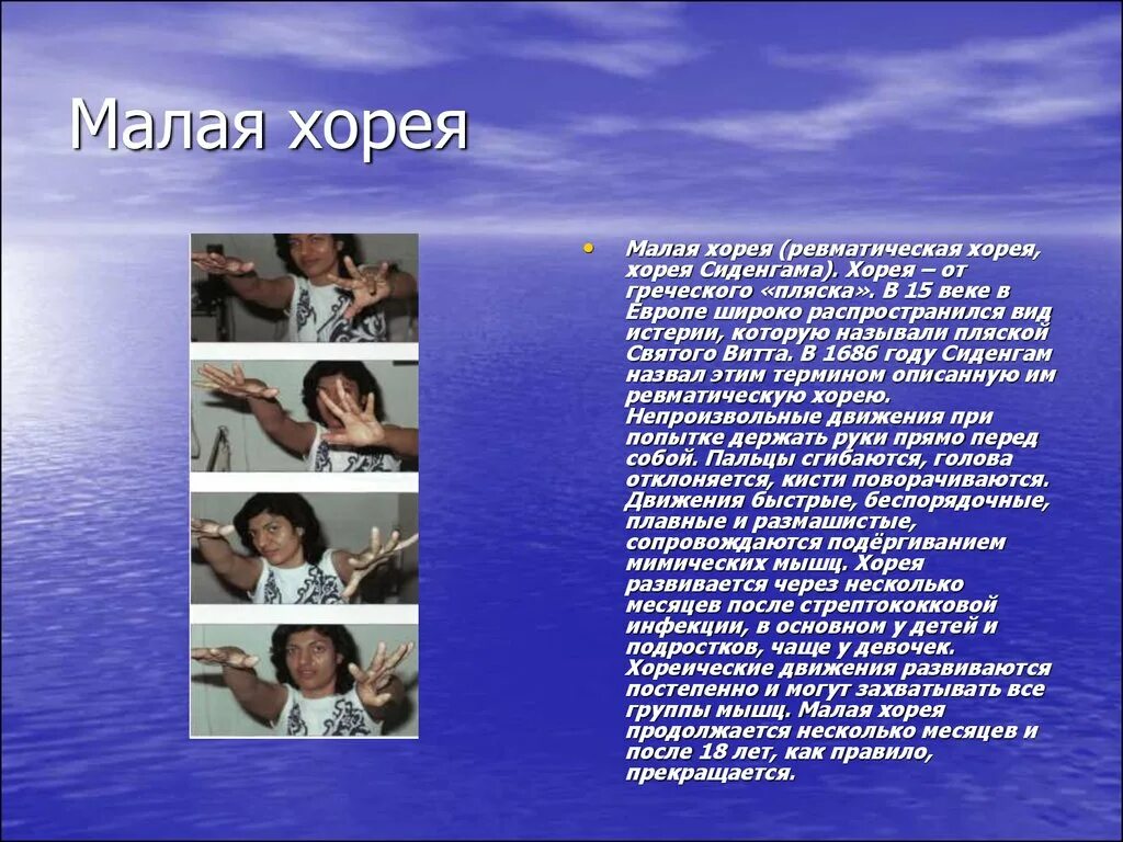 Болезнь пляска святого. Хорея пляска Святого Витта. Ревматическая Хорея (пляска Святого Витта).. Малая Хорея. Малая ревматическая Хорея.