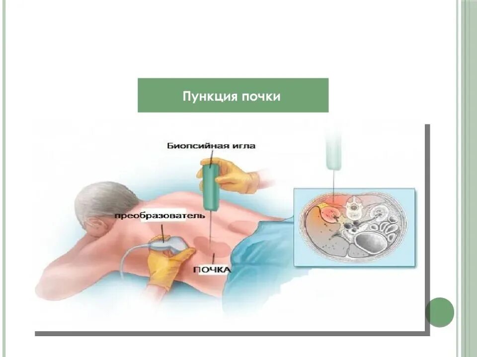 Как берут биопсию у мужчин. Пункциональная биопсия.