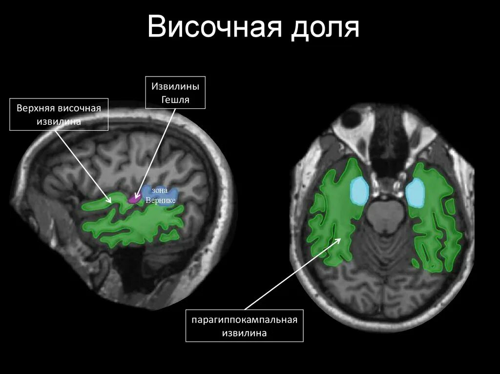 Доли мозга мрт. Извилины височной доли мрт. Парагиппокампальная извилина мрт анатомия.