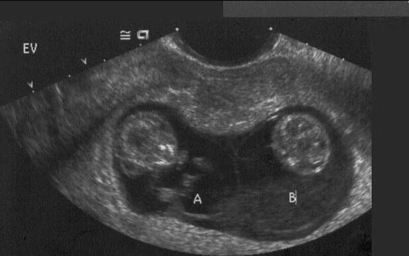 УЗИ 6 недель беременности двойня однояйцевые. УЗИ двойняшек на раннем сроке беременности. УЗИ двойни на ранних сроках беременности 6 недель. УЗИ многоплодной беременности на 6 неделе беременности.