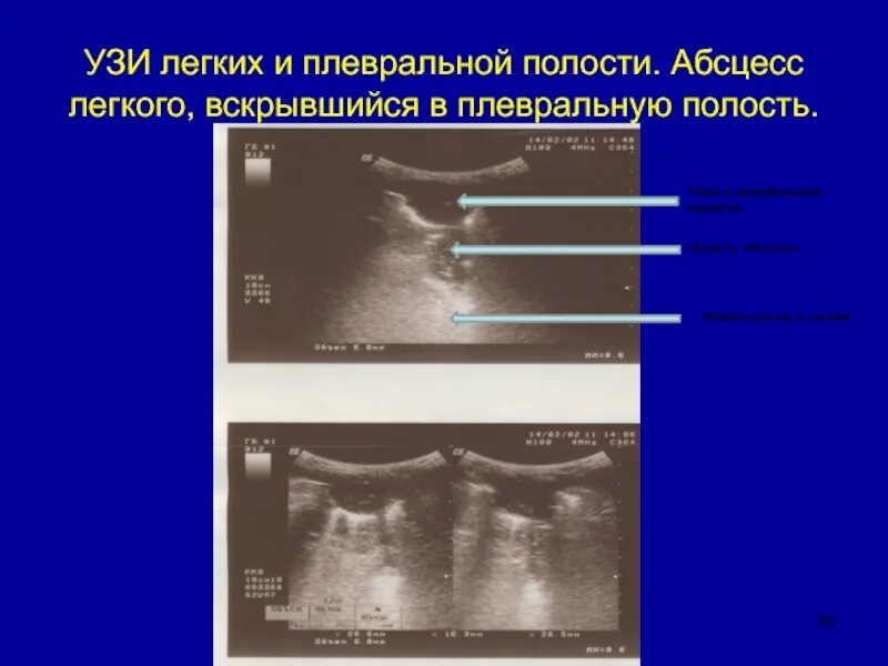Осумкованный плеврит на узи. Экссудативный плеврит узи плевральной полости. Измерение объема жидкости в плевральной полости на узи. Гидроторакс узи плевральных полостей. Объём жидкости в плевральной полости по узи.