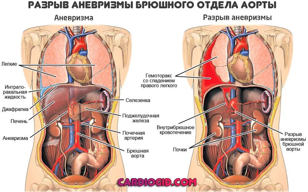 Аневризма брюшного отдела аорты симптомы. Разрыв аневризмы брюшной аорты. Разрыв аорты брюшной полости. Аорта брюшной полости операция