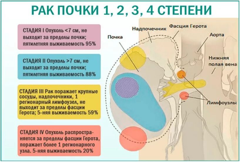 Сколько по времени развивается рак. Новообразование 4 степени почки. Злокачественная опухоль почки.