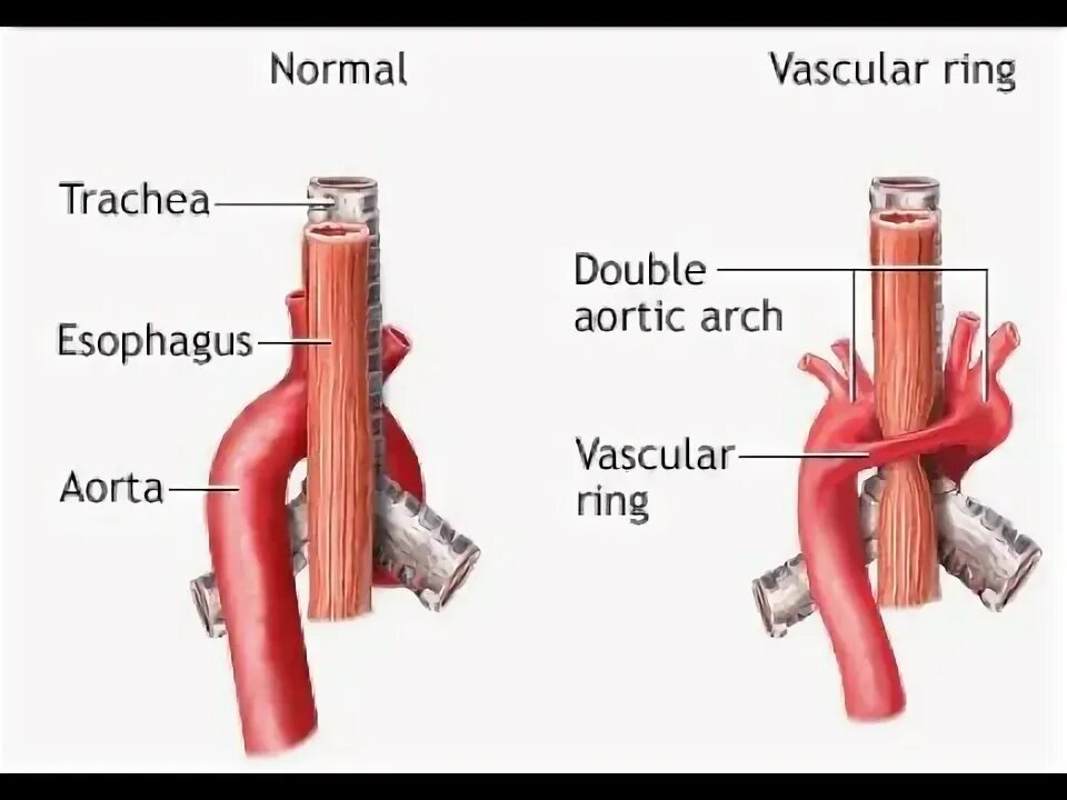 Дуги пищевода. Персистирование дуги аорты. Сосудистое кольцо двойная дуга аорты. Аномалия положения дуги аорты. Персистирование обеих дуг аорты.