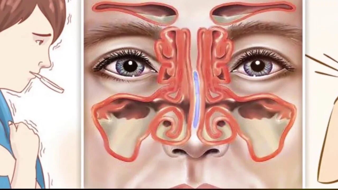 Острый катаральный синусит. Катаральный верхнечелюстной синусит. Вазомоторный ринит риноскопия. Болезнь когда заложен нос