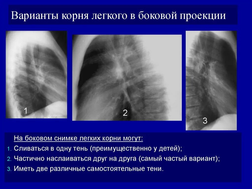 Увеличение корень легкого. ГПОД рентген легких боковая проекция. Правая боковая проекция легких. Корень легкого на рентгенограмме.