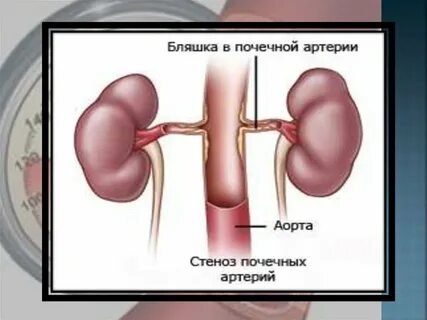 Почечная артерия диаметр
