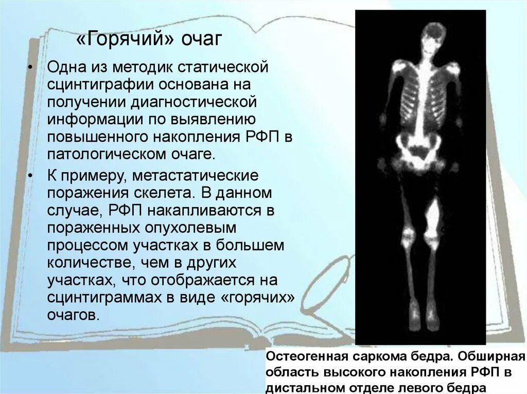 Метастатическое поражение кости. Метастатическое поражение костей скелета. Сцинтиграфия костей скелета (остеосцинтиграфия). Сцинтиграфия костей скелета норма. Горячие и холодные очаги сцинтиграфия костей.