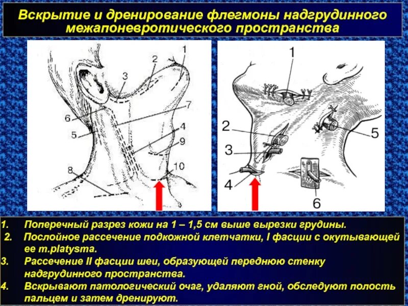 Операция абсцесс шеи. Вскрытие флегмоны надгрудинного межапоневротического пространства. Дренирование флегмон шеи. Разрезы для вскрытия флегмон шеи. Флегмона поднижнечелюстной области операция.