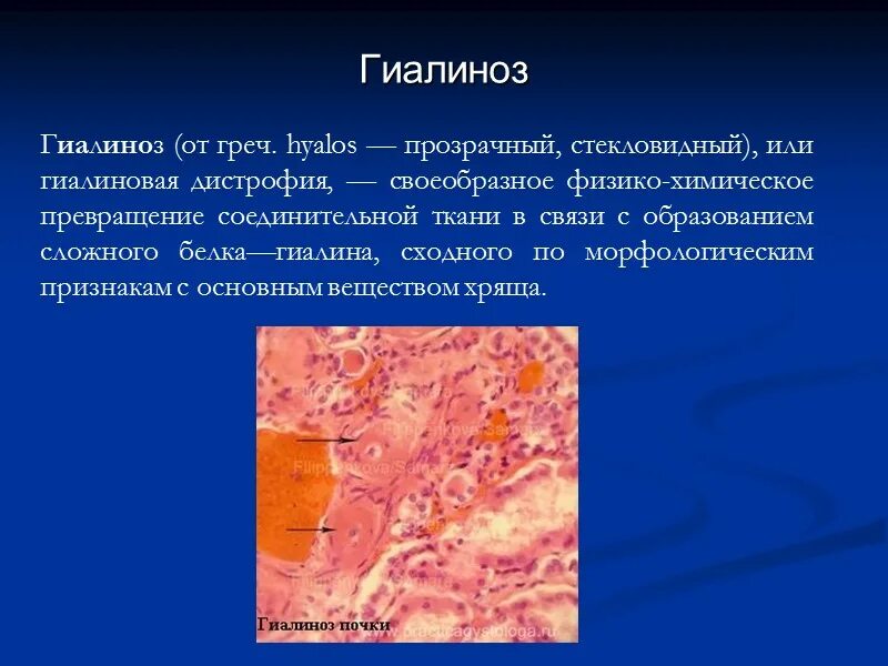Для гиалиноза характерно. Гиалиноз причины. Механизм гиалиноза. Гиалиноз заболевания патогенез. Гиалиноз механизмы развития.
