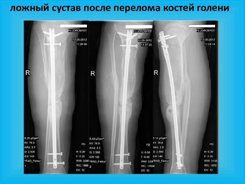 Ложный сустав большеберцовой кости. Псевдоартроз большеберцовой кости рентген. Интрамедуллярный остеосинтез костная мозоль. Ложный сустав после перелома бедренной кости.