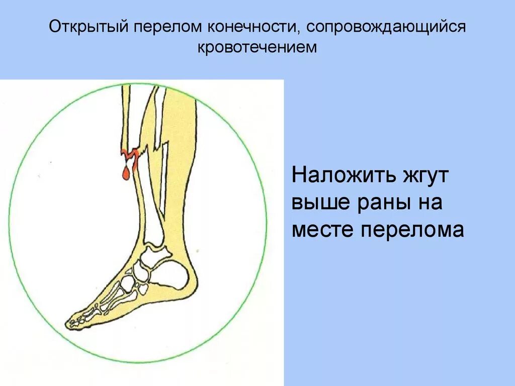 Открытый перелом конечностей.