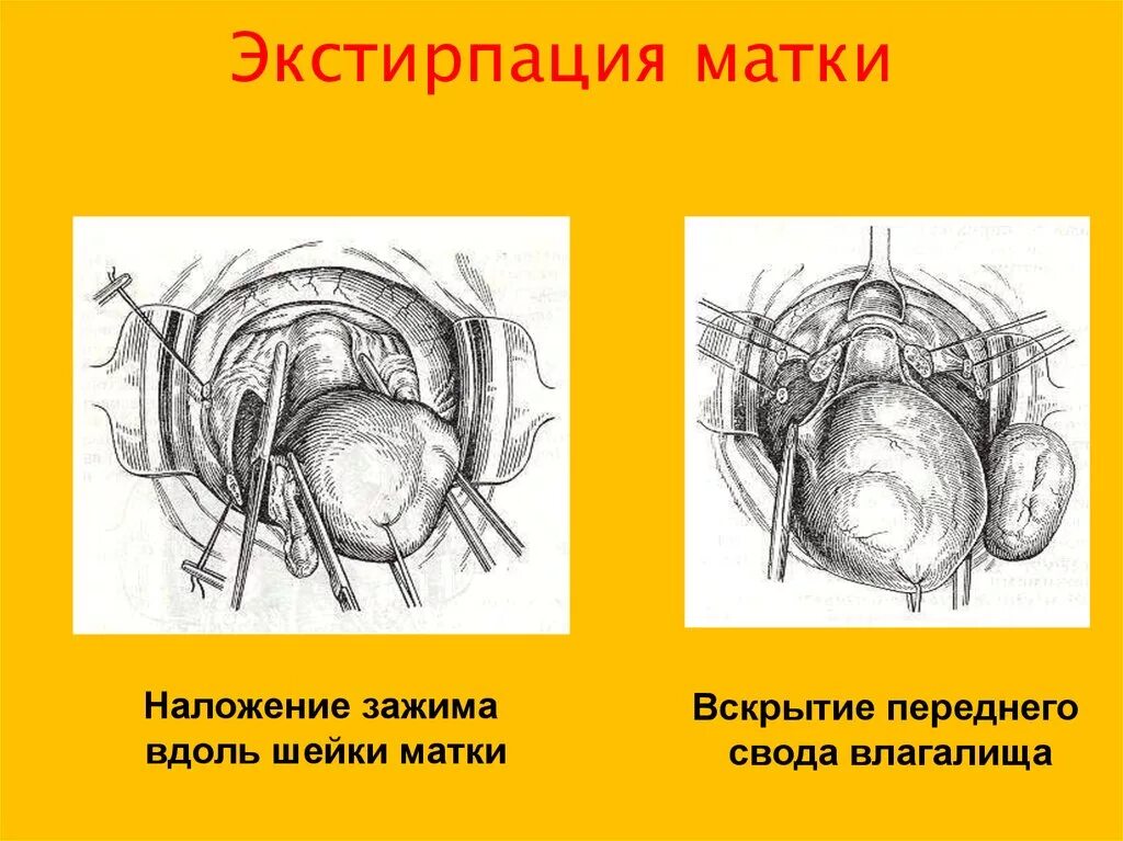 Влагалищная экстирпация матки. Влагалищная экстирпация этапы операции. Экстрафасциальная экстирпация матки. Влагалищная экстирпация матки ход операции. Передний свод