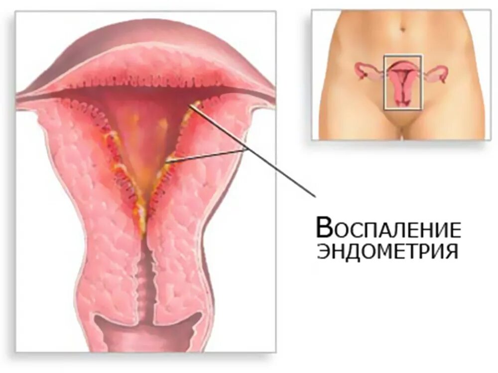 Воспаления внутренней оболочки матки. Послеродовой эндометрит. Герпетический эндометрит. Эндометрит это воспаление.