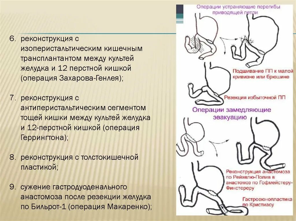 Операции при синдроме приводящей петли. Синдром приводящей петли причины. Приводящая петля кишки. Синдром приводящей петли после резекции желудка по Бильрот 2.