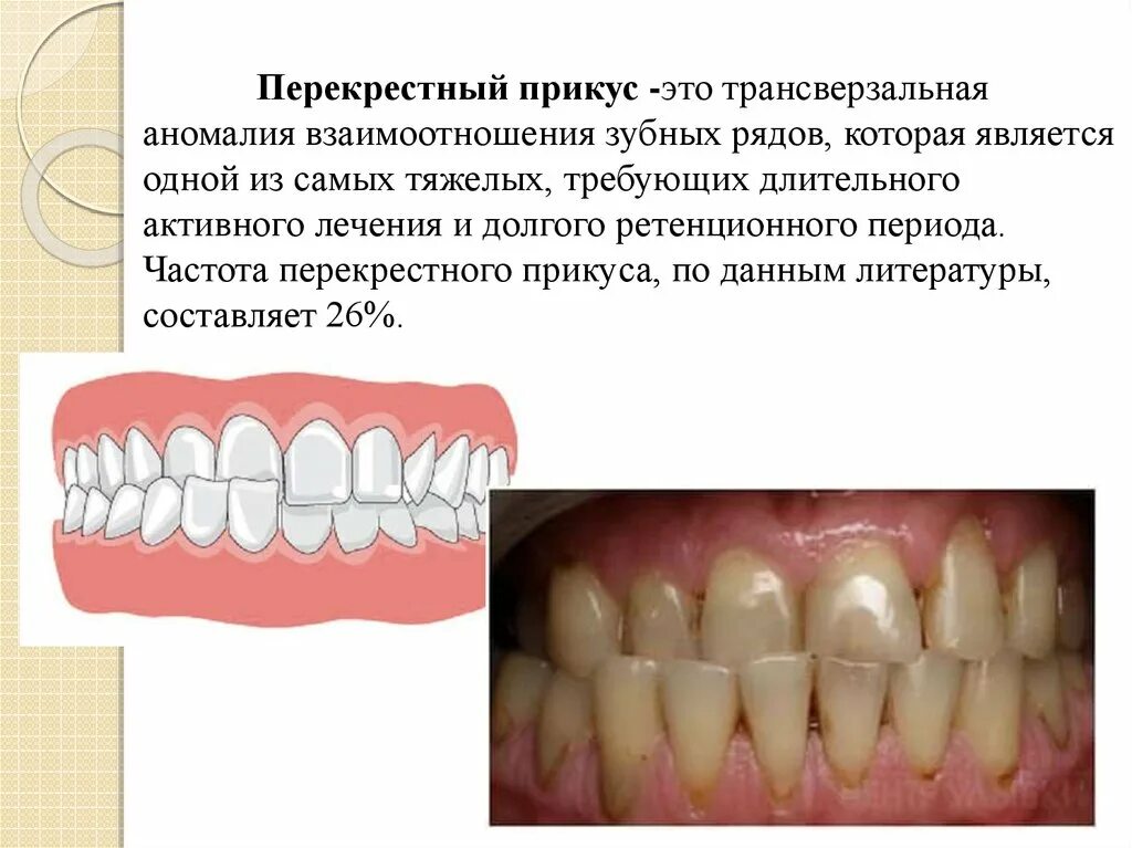 Перекрестные зубы
