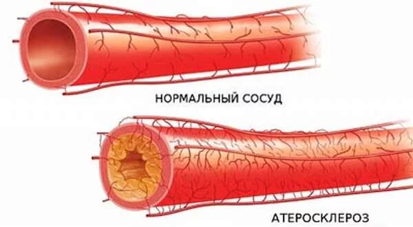 Осложнения заболеваний сосудов. Последствия атеросклероза сосудов. Хроническое заболевание сосудов