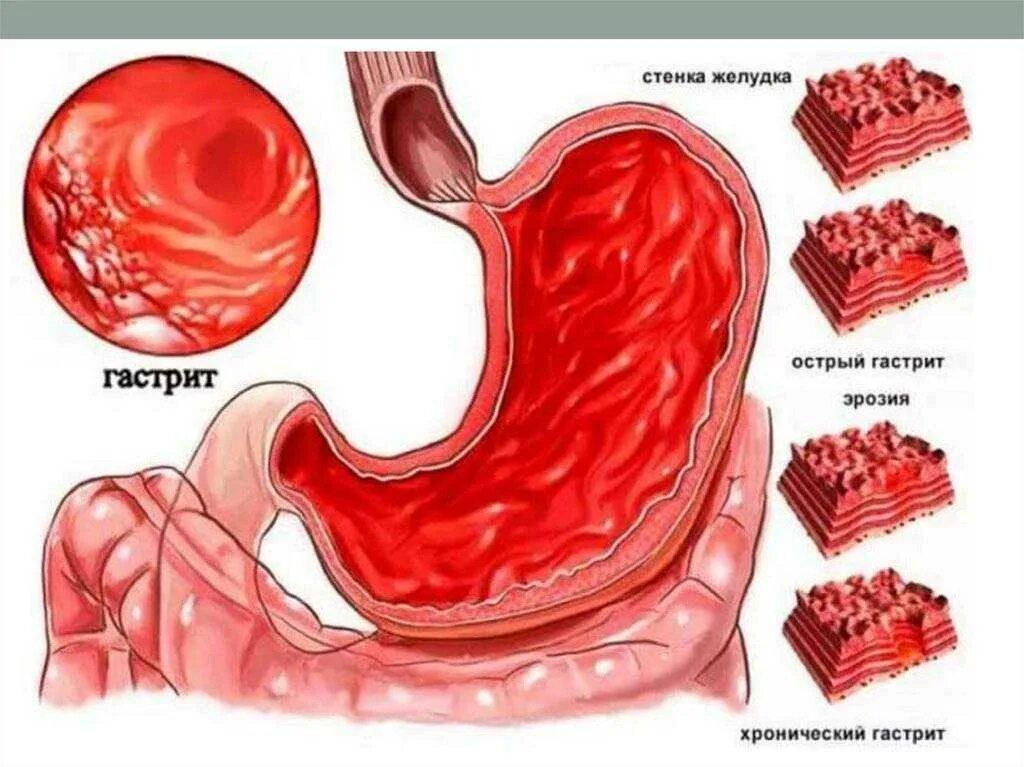 Хронический гастродуоденит и язвенная болезнь. Острый катаральный гастрит. Хронический антральный гастрит этиология. Лечение язвы желудка у взрослых